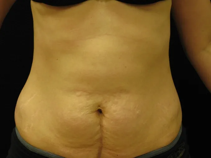 before-after-tummy-tuck-abdominoplasty-1212a