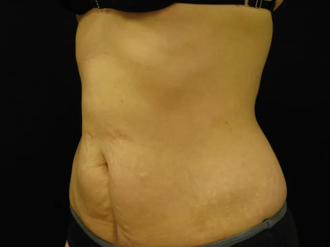 before-after-tummy-tuck-abdominoplasty-1212a