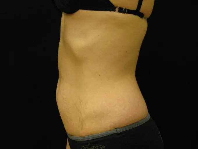 before-after-tummy-tuck-abdominoplasty-1212a