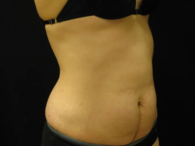 before-after-tummy-tuck-abdominoplasty-1212a