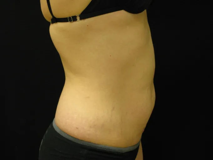 before-after-tummy-tuck-abdominoplasty-1212a