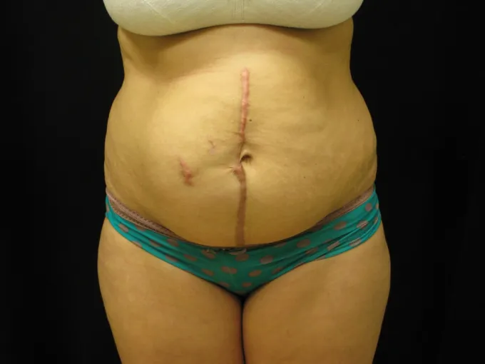 before-after-tummy-tuck-abdominoplasty-1212a