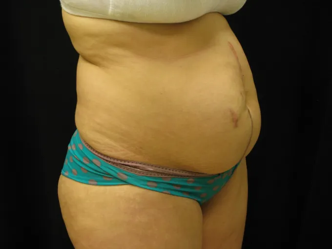 before-after-tummy-tuck-abdominoplasty-1212a