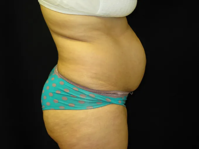before-after-tummy-tuck-abdominoplasty-1212a