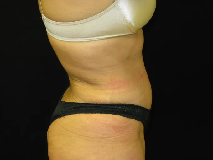 before-after-tummy-tuck-abdominoplasty-2929f