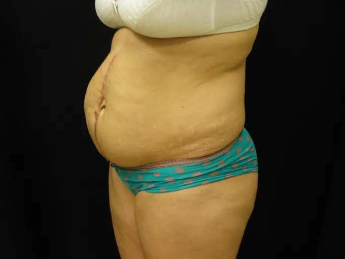before-after-tummy-tuck-abdominoplasty-1212a