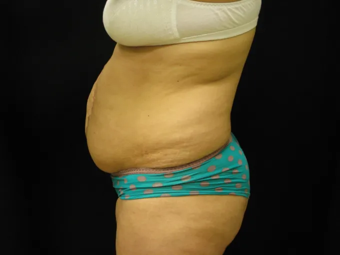 before-after-tummy-tuck-abdominoplasty-1212a