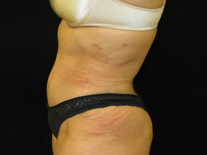 before-after-tummy-tuck-abdominoplasty-2929j