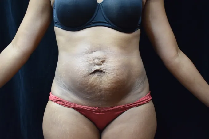 before-after-tummy-tuck-abdominoplasty-1212a