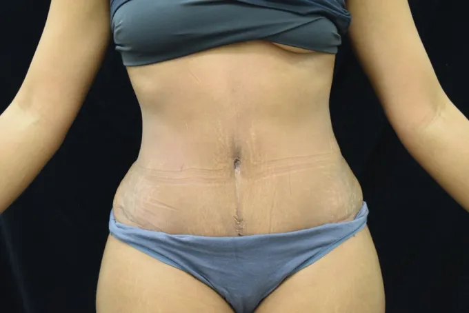 before-after-tummy-tuck-abdominoplasty-3131b