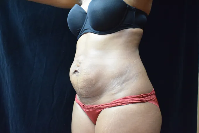 before-after-tummy-tuck-abdominoplasty-1212a