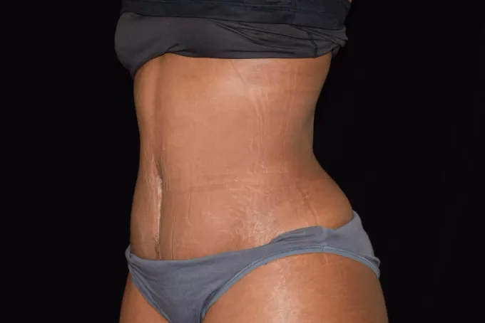 before-after-tummy-tuck-abdominoplasty-3131d