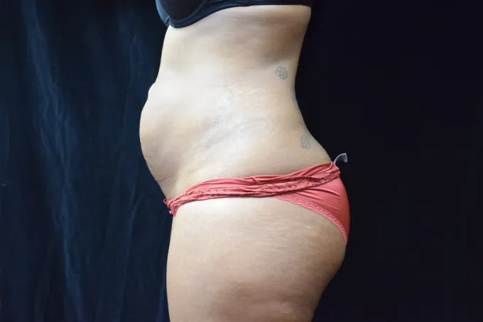 before-after-tummy-tuck-abdominoplasty-1212a