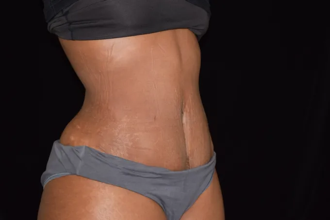 before-after-tummy-tuck-abdominoplasty-3131h