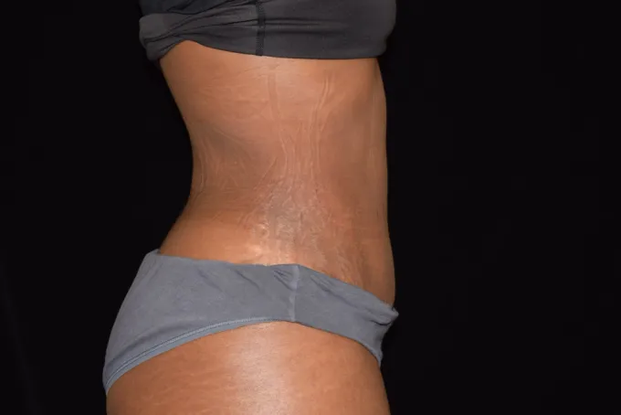 before-after-tummy-tuck-abdominoplasty-3131j