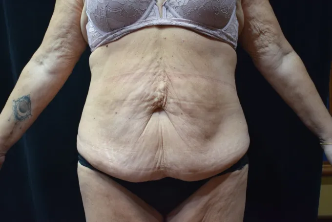 before-after-tummy-tuck-abdominoplasty-1212a