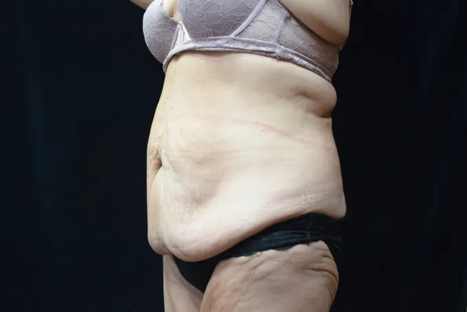 before-after-tummy-tuck-abdominoplasty-1212a