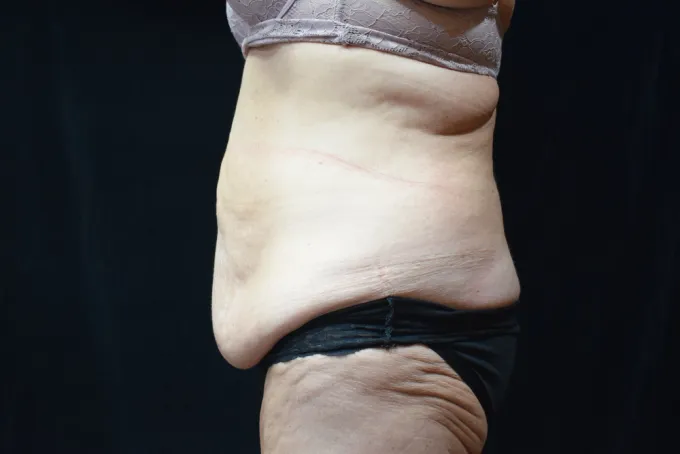 before-after-tummy-tuck-abdominoplasty-1212a