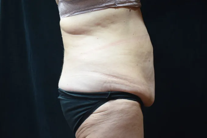 before-after-tummy-tuck-abdominoplasty-1212a