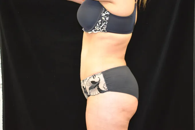 before-after-tummy-tuck-abdominoplasty-33f