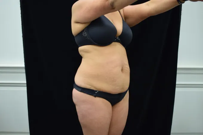 before-after-tummy-tuck-abdominoplasty-33g