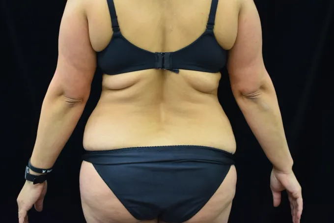 before-after-tummy-tuck-abdominoplasty-33k