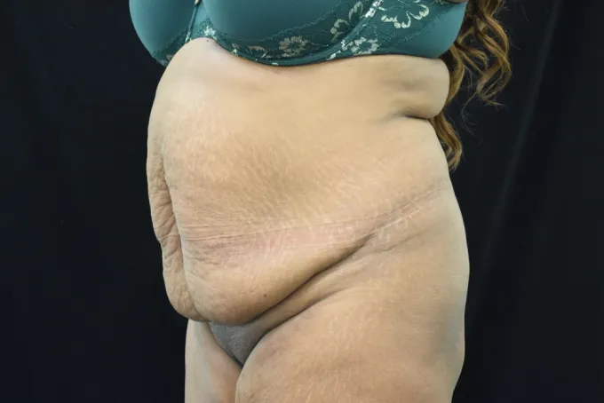 before-after-tummy-tuck-abdominoplasty-1212a