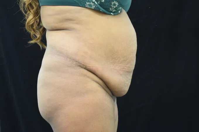 before-after-tummy-tuck-abdominoplasty-1212a