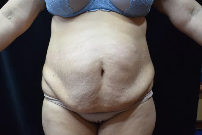 before-after-tummy-tuck-abdominoplasty-44a