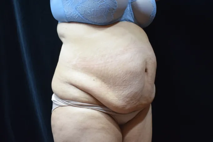 before-after-tummy-tuck-abdominoplasty-44g