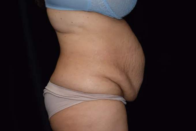 before-after-tummy-tuck-abdominoplasty-44j