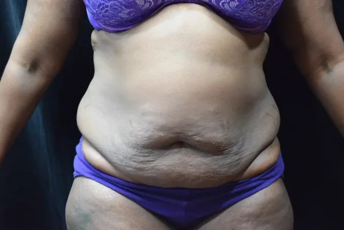 before-after-tummy-tuck-abdominoplasty-51a