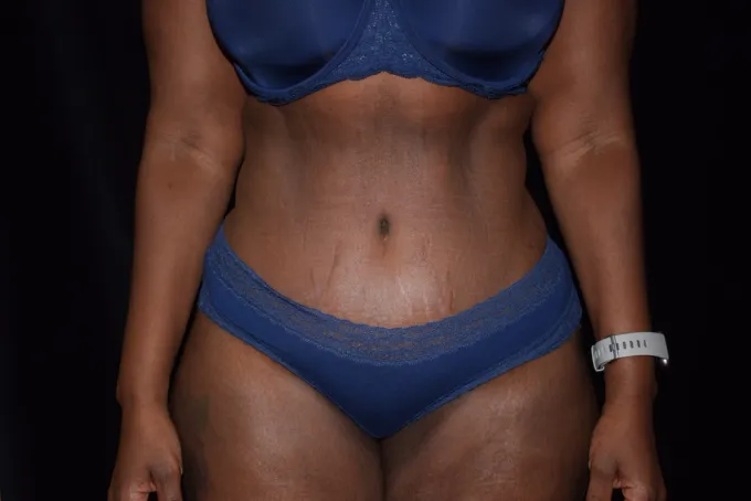 before-after-tummy-tuck-abdominoplasty-51b