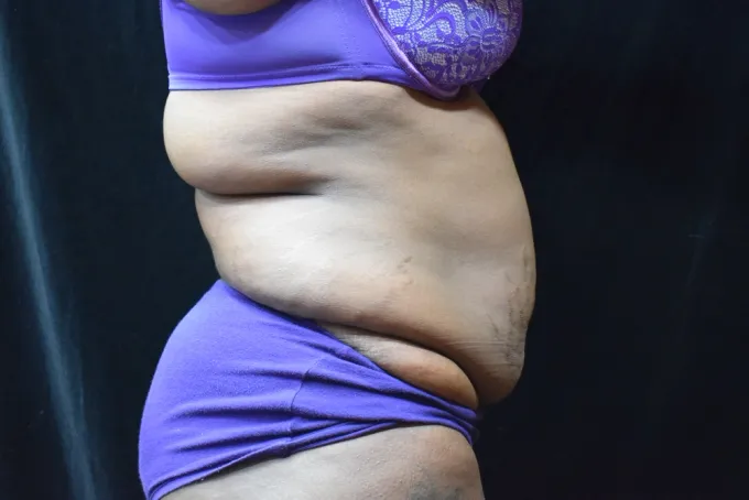 before-after-tummy-tuck-abdominoplasty-51i