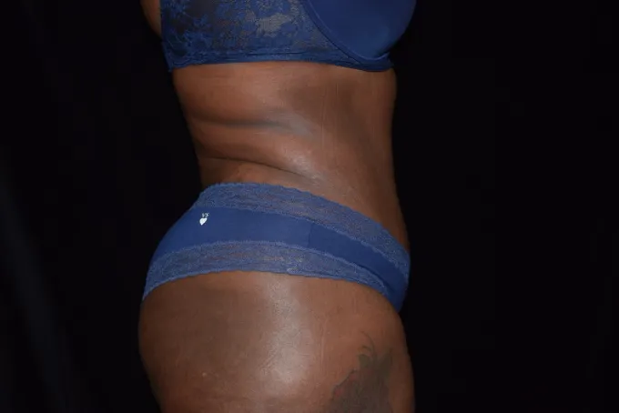 before-after-tummy-tuck-abdominoplasty-51j