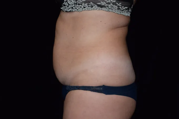 before-after-tummy-tuck-abdominoplasty-66e