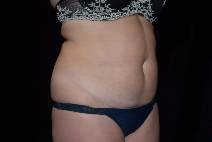 before-after-tummy-tuck-abdominoplasty-66g