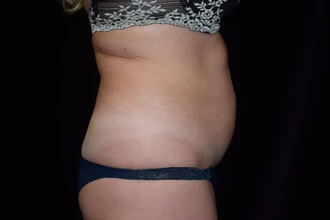 before-after-tummy-tuck-abdominoplasty-66i