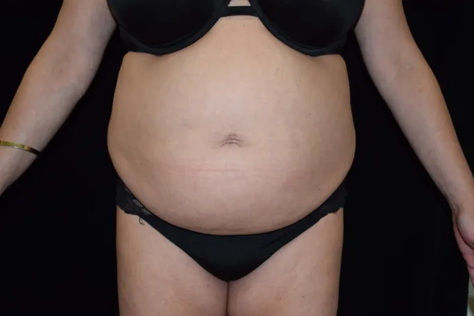 before-after-tummy-tuck-abdominoplasty-88a