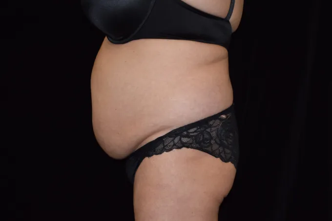 before-after-tummy-tuck-abdominoplasty-88e