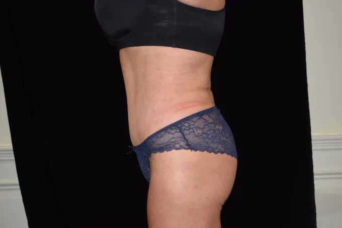 before-after-tummy-tuck-abdominoplasty-88f