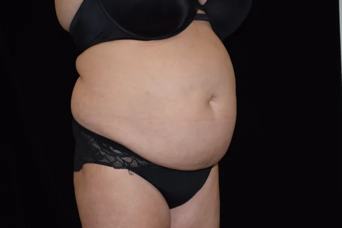before-after-tummy-tuck-abdominoplasty-88g