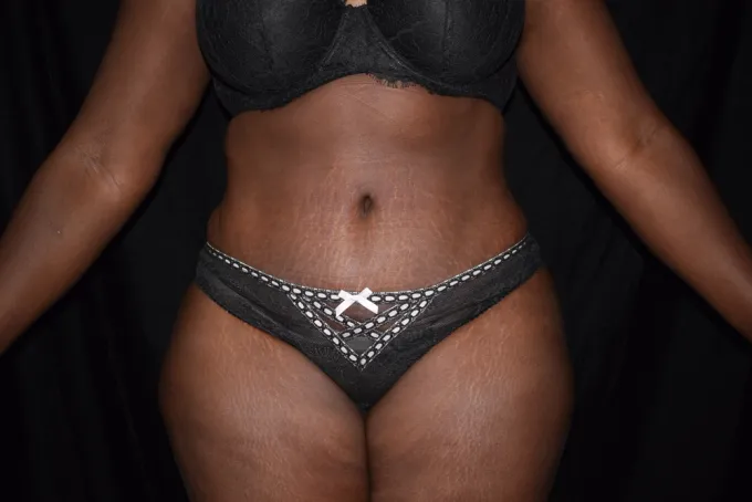 before-after-tummy-tuck-abdominoplasty-99b