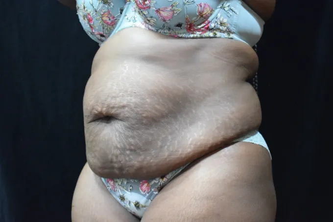 before-after-tummy-tuck-abdominoplasty-99c