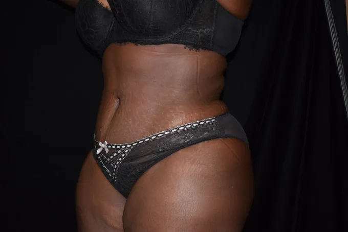 before-after-tummy-tuck-abdominoplasty-99d