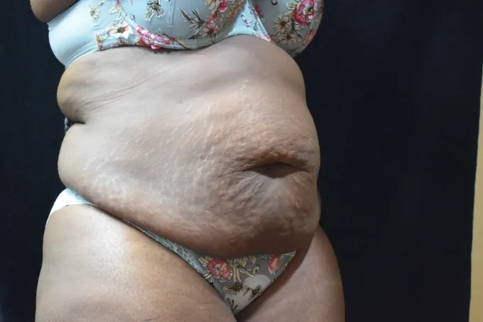 before-after-tummy-tuck-abdominoplasty-99g