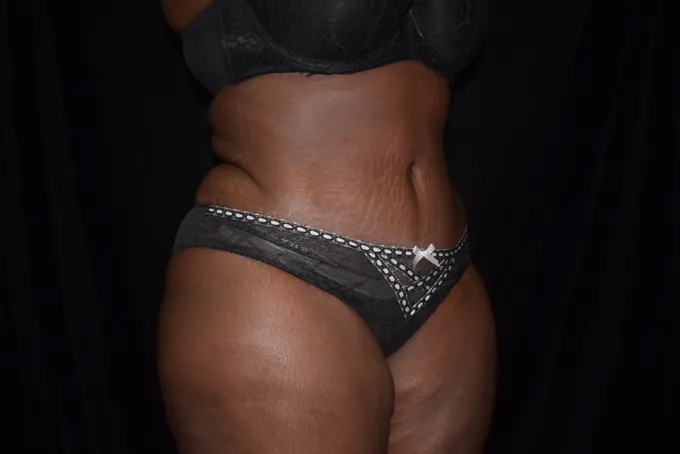 before-after-tummy-tuck-abdominoplasty-99h