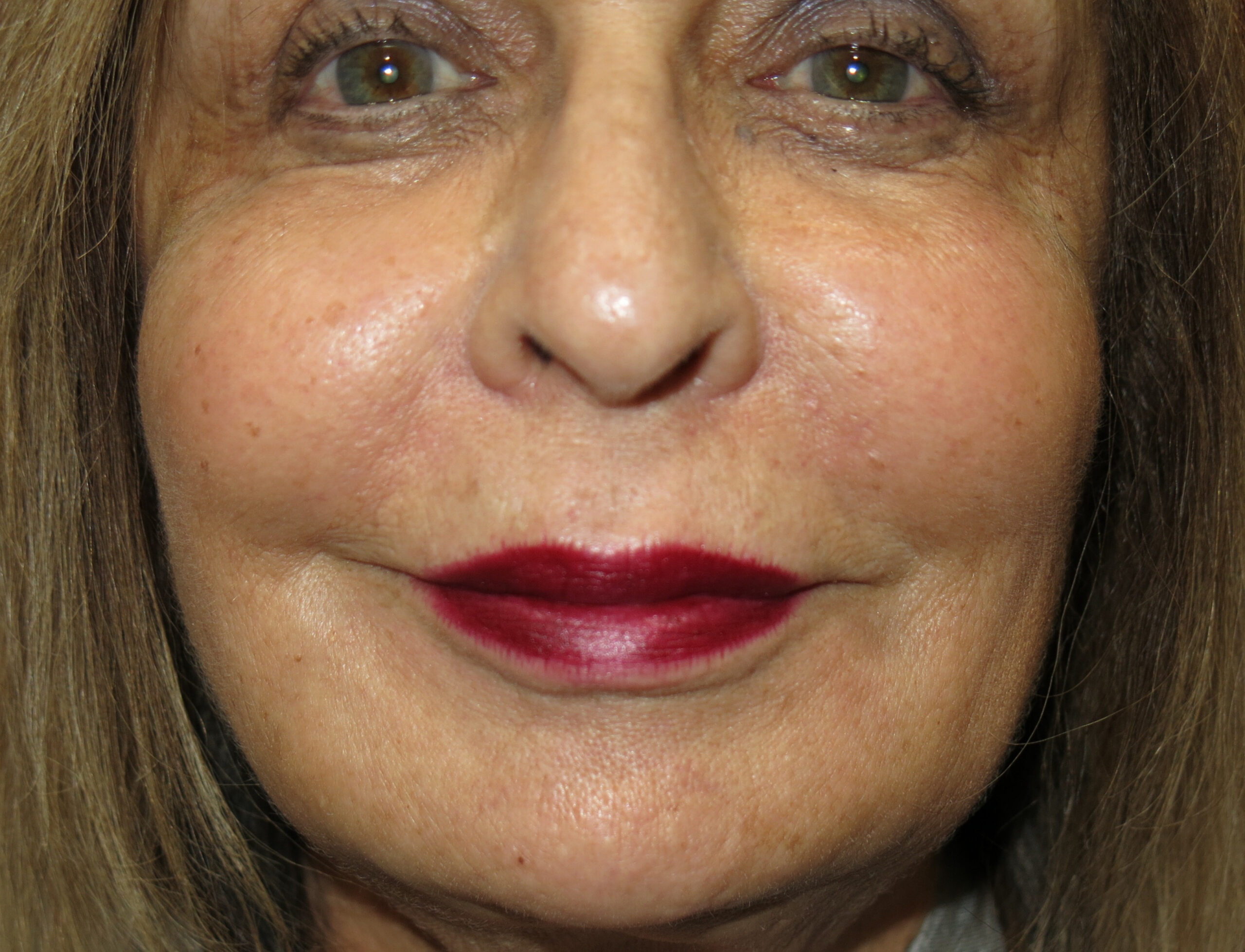 cheek after - Dr. Joseph A. Racanelli Close-up of a woman's lower face with bold red lipstick and a small smile visible at the lips surface.