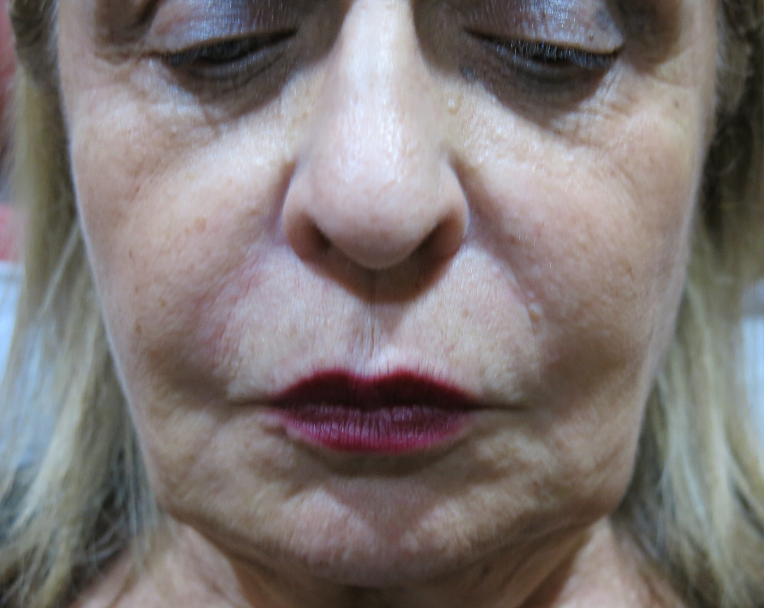 cheek before - Dr. Joseph A. Racanelli Close-up of a woman's face with eyes closed, showing textured skin and light makeup.