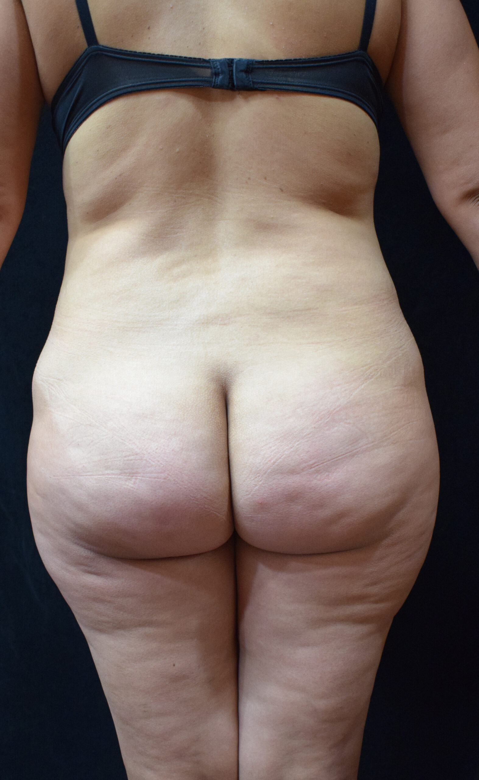 Back view of a person wearing a navy bikini bottom, standing against a dark background; torso and buttocks visible.